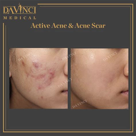 Da Vinci Clinic - Acne Scars Treatment using PICO Laser