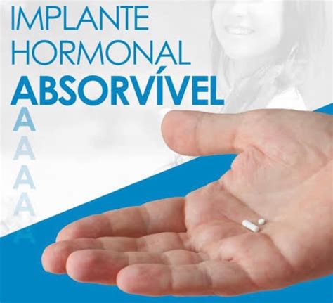 Implantes Hormonais Guia Saúde Cidades