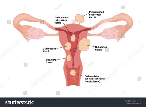 Types Uterine Fibroids Vector Medical Illustration Stock Vector