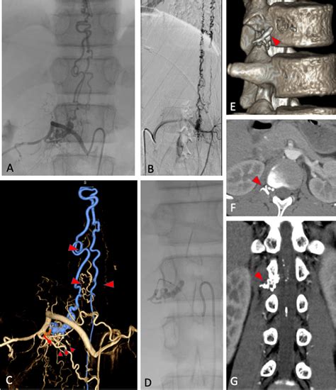 Antero Posterior A And Lateral B Views And Three Dimensional