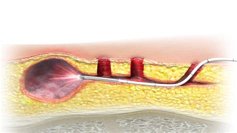 Illustration Behandlung Pilonidalsinus MedicalGraphics