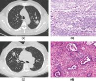 Dual Energy Ct Based Radiomics For Predicting Pathological Grading Of