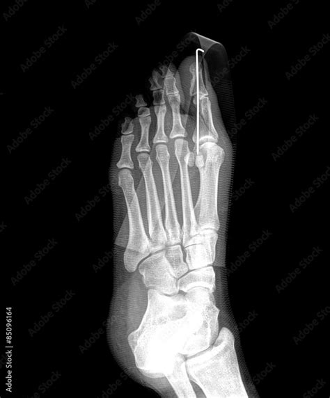 Film X Ray Show Fracture Proximal Phalange At First Toe Stock Photo