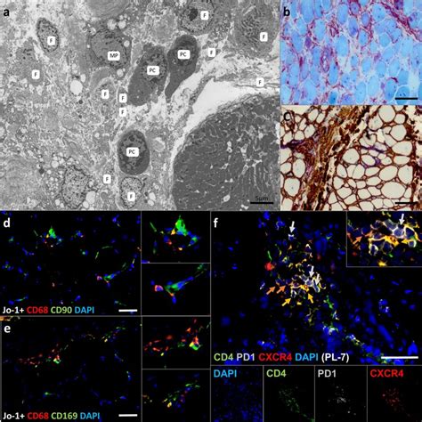 Electron Microscopy Dissects The Plasma Cell Micro Milieu In Asys