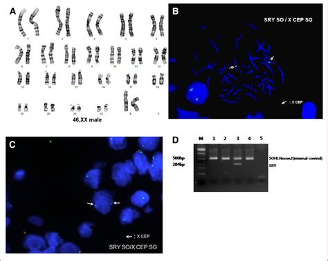 Figure 2 From Sry Negative 46 Xx Infertile Male With Leydig Cell