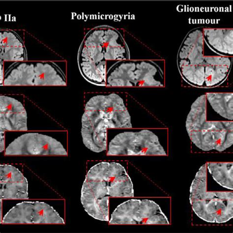 Examples Of Qsm And R Maps Obtained In The Clinical Setting For