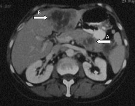 Ct Scan Of The Abdomen Showing A Mass In The Tail Of The Pancreas A