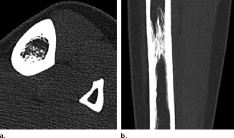 Intramedullary Osteosclerosis Axial A And Coronal B Ct Scans