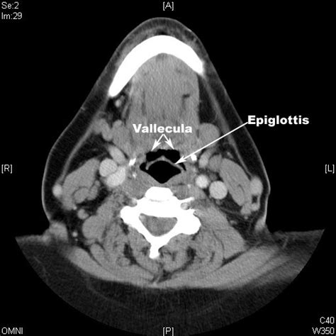 locate vallecula and epiglottis