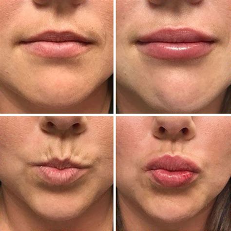 What Do Your Lips Look Like After Fillers Lipstutorial Org