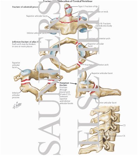 Fracture And Dislocation Of Cervical Vertebrae Trauma