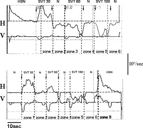 Hst And Svint In A Case Of Left Vestibular Neuritis Nystagmus Download Scientific Diagram