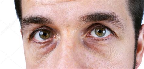 Man with very tired eyes Stock Photo by ©Mirage3 17880213