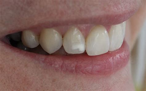 White Spots On Teeth Reasons And Treatment Smile Team Turkey