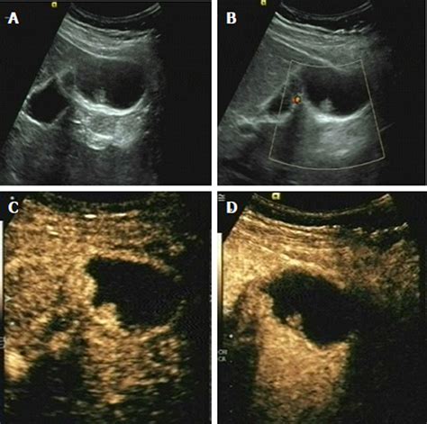 Gallbladder Polyps Ultrasound