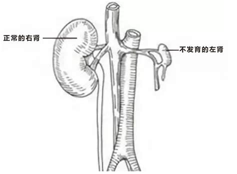 21歲小伙腹痛半月，左腎莫名「消失」！右腎結石「肥」一圈 每日頭條