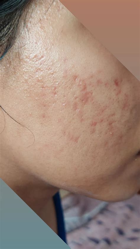 Acne How Can I Get Rid Of My Acne Scarring Rskincareaddiction