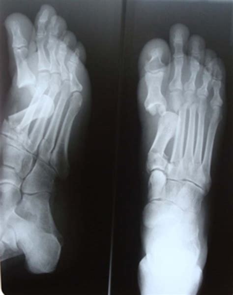 Unusual Case of Irreducible Fracture Dislocation of Great Toe: A case ...