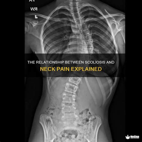 The Relationship Between Scoliosis And Neck Pain Explained Medshun