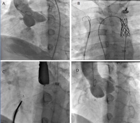 A Aortic Root Angiography In Left Anterior Oblique With Cranial