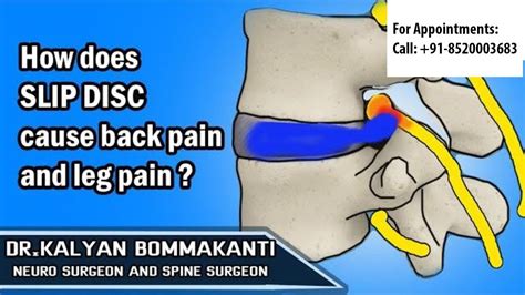 How Does Slip Disc Cause Back Pain And Leg Pain Youtube