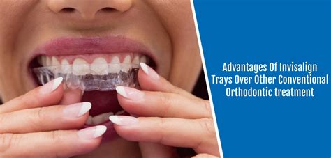 Advantages Of Invisalign Trays Over Other Conventional Orthodontic