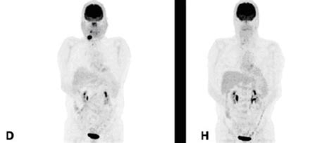 What Is A FDG PET Scan and Why Does It Matter?