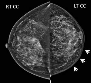 Mammogram Skin Thickening Post Radiotherapy Radiology Cases