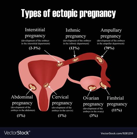 Types Of Uterine Fibroids Endometriosis Royalty Free Vector