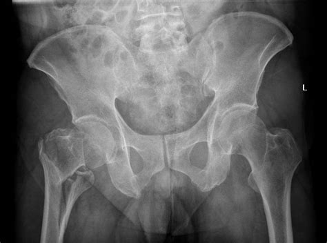 Intertrochanteric Fracture