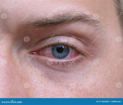 Close Up Irritated Infected Red Bloodshot Eyes Conjunctivitis