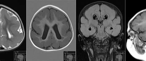 Radiology MRI: Lissencephaly