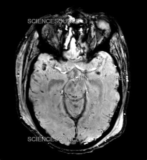 Traumatic Brain Injury MRI | Stock Image - Science Source Images