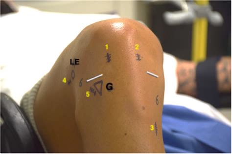 Front View Of The Right Knee With Bony Landmarks And Skin Incisions G