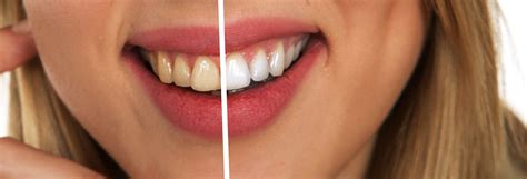 Important Principles For The Perfect Smile St Johns Wood Nw8 Smilemore