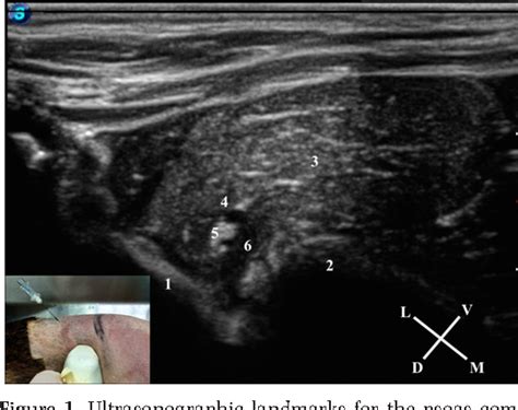 Figure 1 From A Description Of A Technique For Ultrasound Guided Lumbar