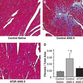 The Effect Of At R Transduction On Perivascular Fibrosis Following Ang