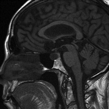 Rathke Cleft Cyst Radiology Reference Article Radiopaedia Org