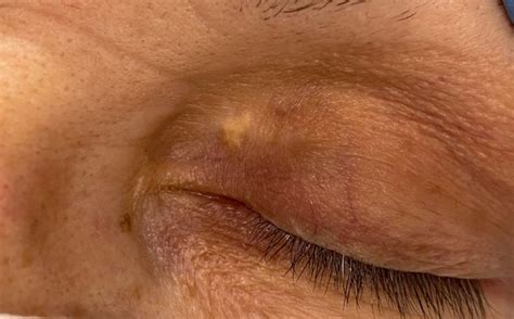 Xanthelasma