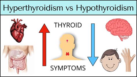 Hyperthyroidism Vs Hypothyroidism