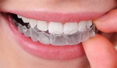 How To Get A Straighter Smile As An Adult With Invisalign Jenkintown