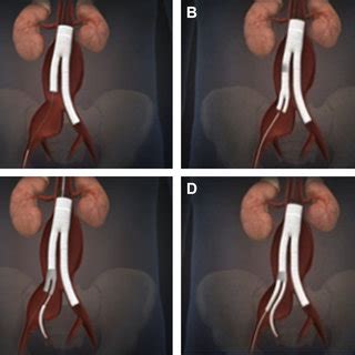 A Paired Viabahn Stent Grafts Stitched Together Forming A Common