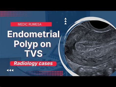 Endometrial Polyp On Transvaginal Ultrasound Radiology Case Youtube