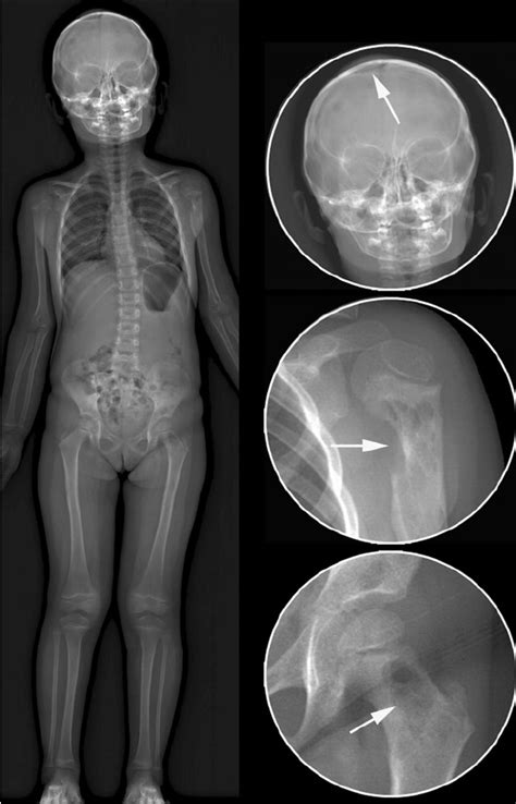 Low-dose biplanar skeletal survey (anteroposterior view) reveals bone ...