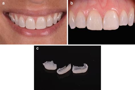 At-Home Tray Whitening and Direct Resin-Based Composite Restorations ...