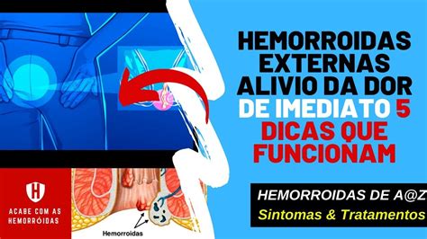 Hemorroidas Externas💜💜alivio Da Dor De Imediato 5 Dicas Que Funcionam