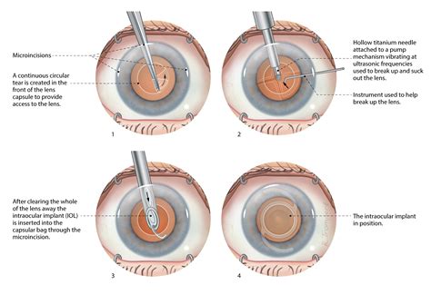ESCRS - Cataract surgery