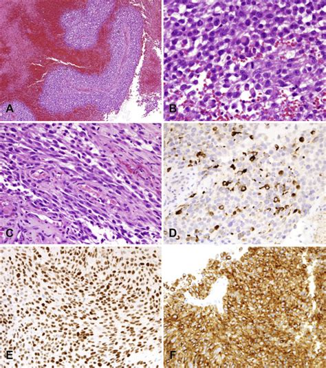 Rhabdomyosarcoma With FUS Re Arrangement Additional Case In Support Of