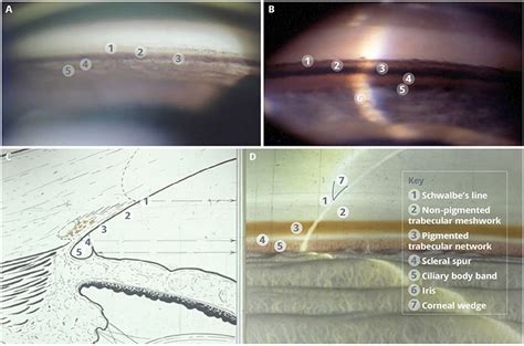 Gonioscopy Corneal Wedge