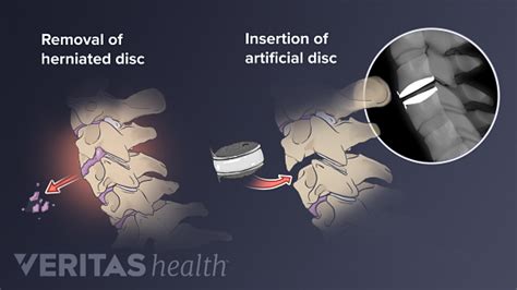 Cervical Artificial Disc Replacement Surgery